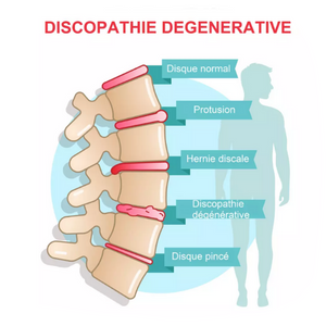 Soins chiropraxie hernie discale, discopathie Besançon